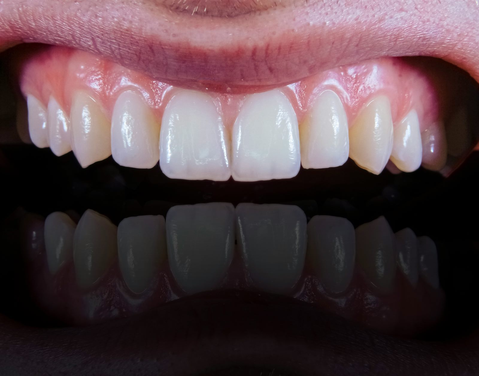 Composite Bonding (Lahore)