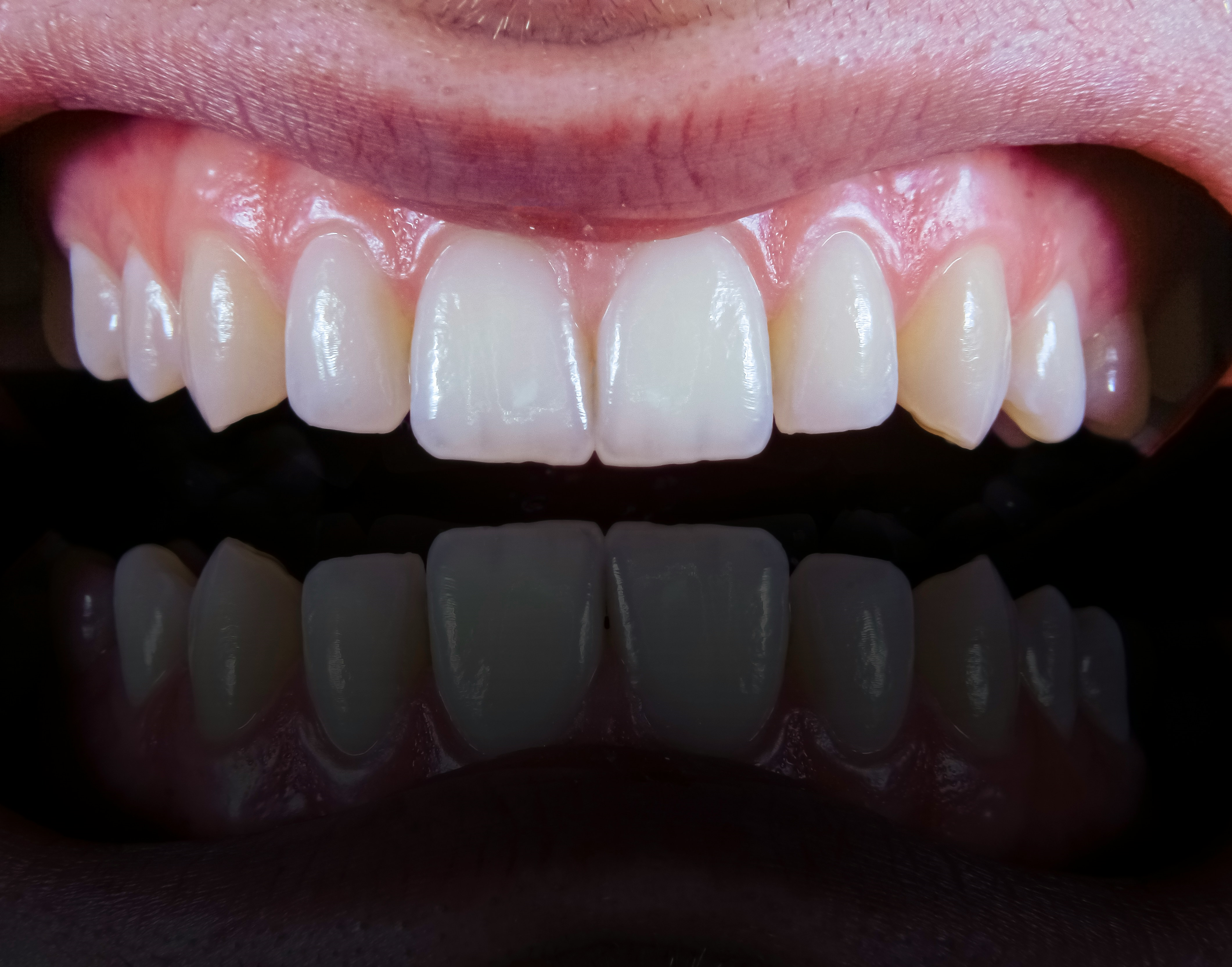 Composite Bonding (Lahore)
