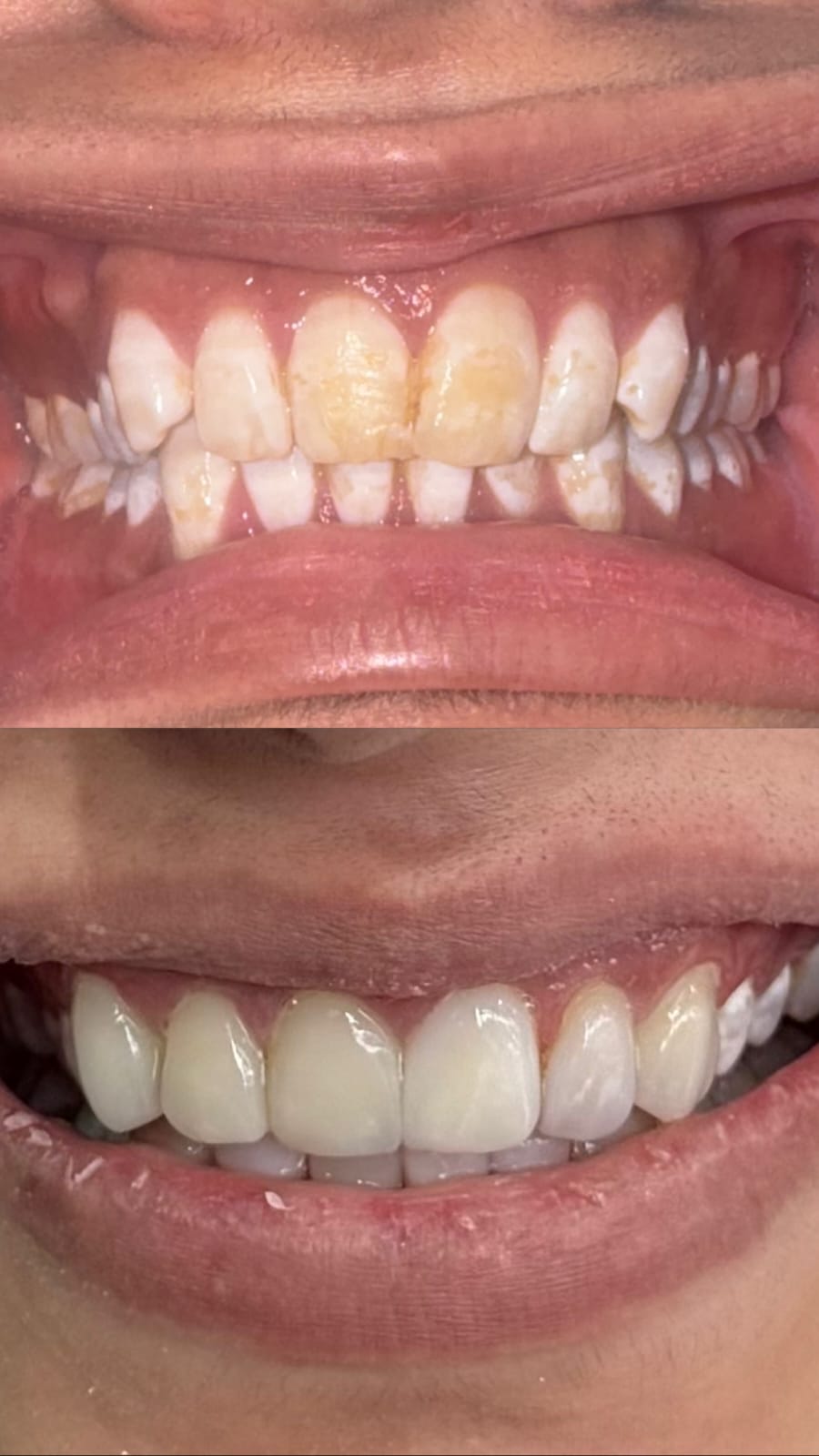 Emax veneers in DHA Lahore