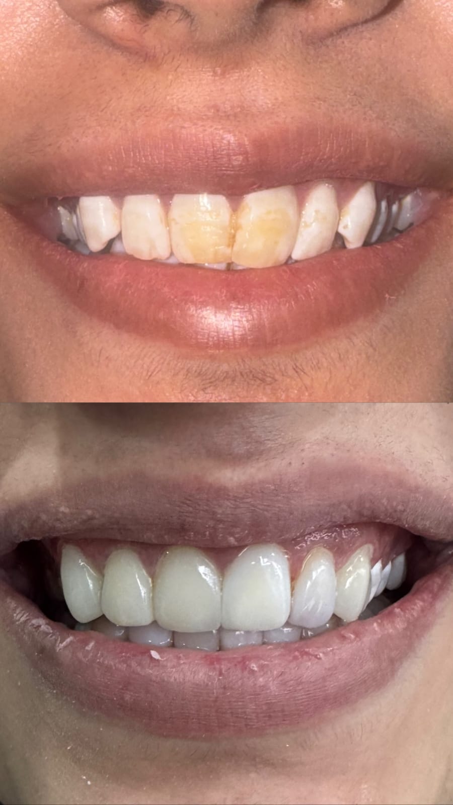 Dental veneers in Lahore