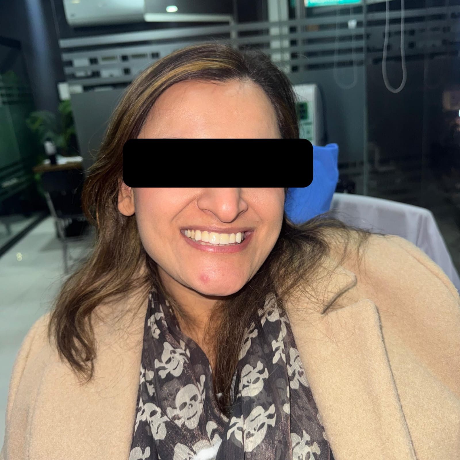 Dental veneers patient in DHA Phase 5 Lahore