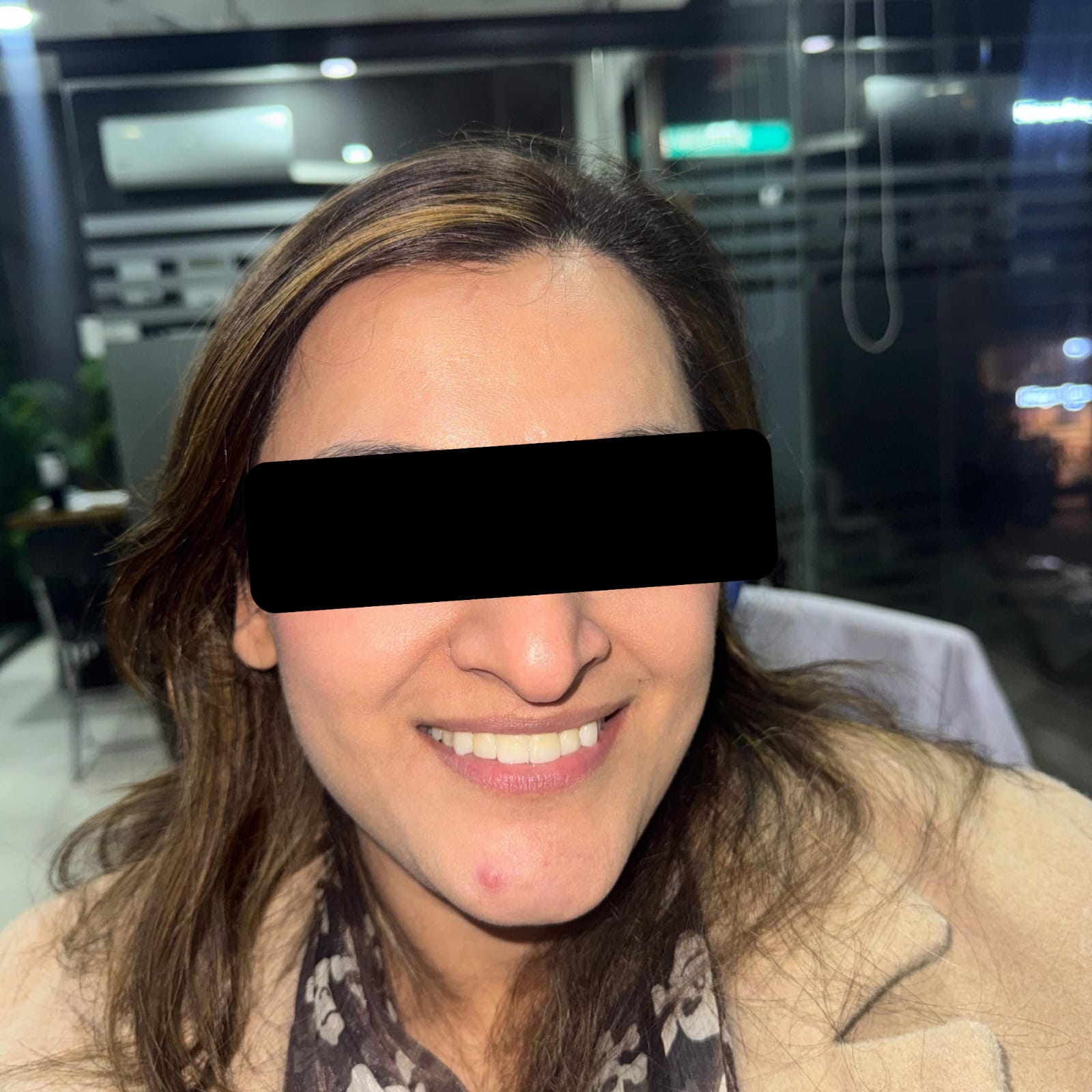 Dental veneers patient in Lahore