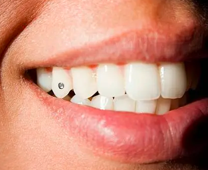 Tooth Gems in Lahore DHA